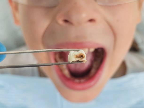 Best Urgent Care for Lost Fillings or Crowns in Union Mill, VA